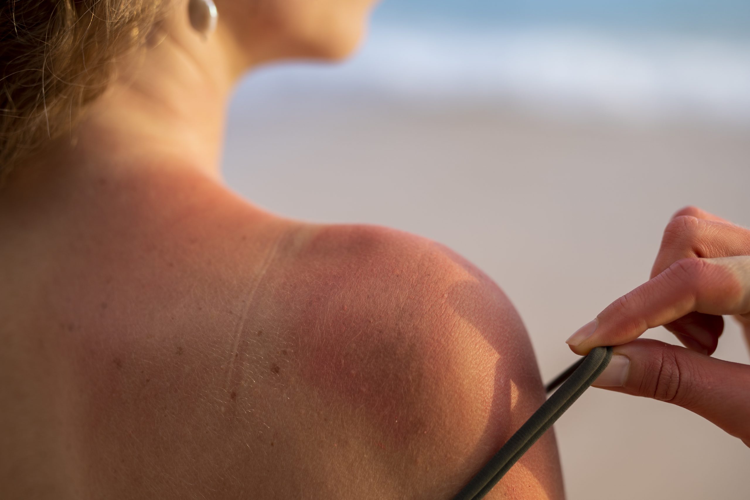 detalhes-da-pele-queimada-pelo-sol-da-praia-de-uma-mulher